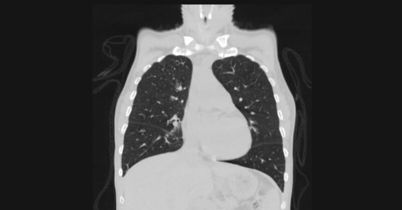 File:Angioinvasive aspergellosis (Radiopaedia 66995-76315 Coronal lung window 24).jpg