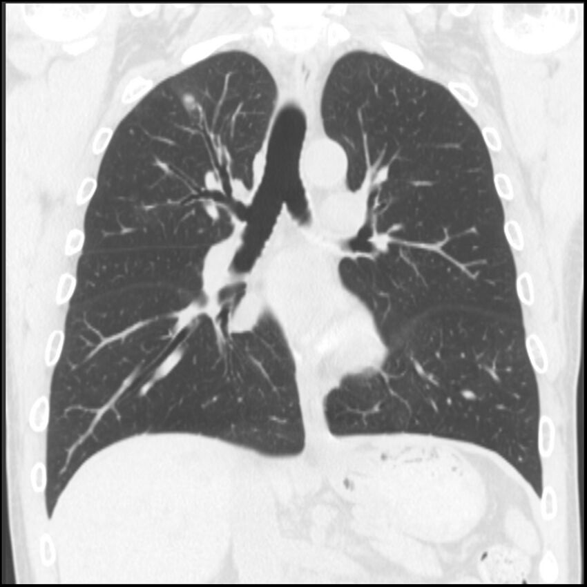 Angioinvasive aspergillosis (Radiopaedia 43957-47466 Coronal lung window 46).jpg