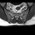 Ankylosing spondylitis with zygapophyseal arthritis (Radiopaedia 38433-40517 B 8).jpg