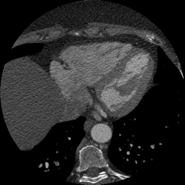 File:Anomalous origin of left circumflex artery from right coronary sinus (Radiopaedia 72563-83117 B 134).jpg