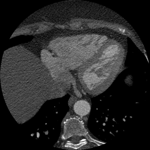 File:Anomalous origin of left circumflex artery from right coronary sinus (Radiopaedia 72563-83117 B 136).jpg