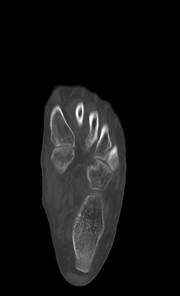 File:Anterior calcaneal process fracture (Radiopaedia 47384-51989 Axial bone window 21).png