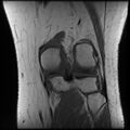 Anterior cruciate ligament tear, Wrisberg rip and bucket-handle tear of medial meniscus (Radiopaedia 75872-87266 Coronal T1 20).jpg
