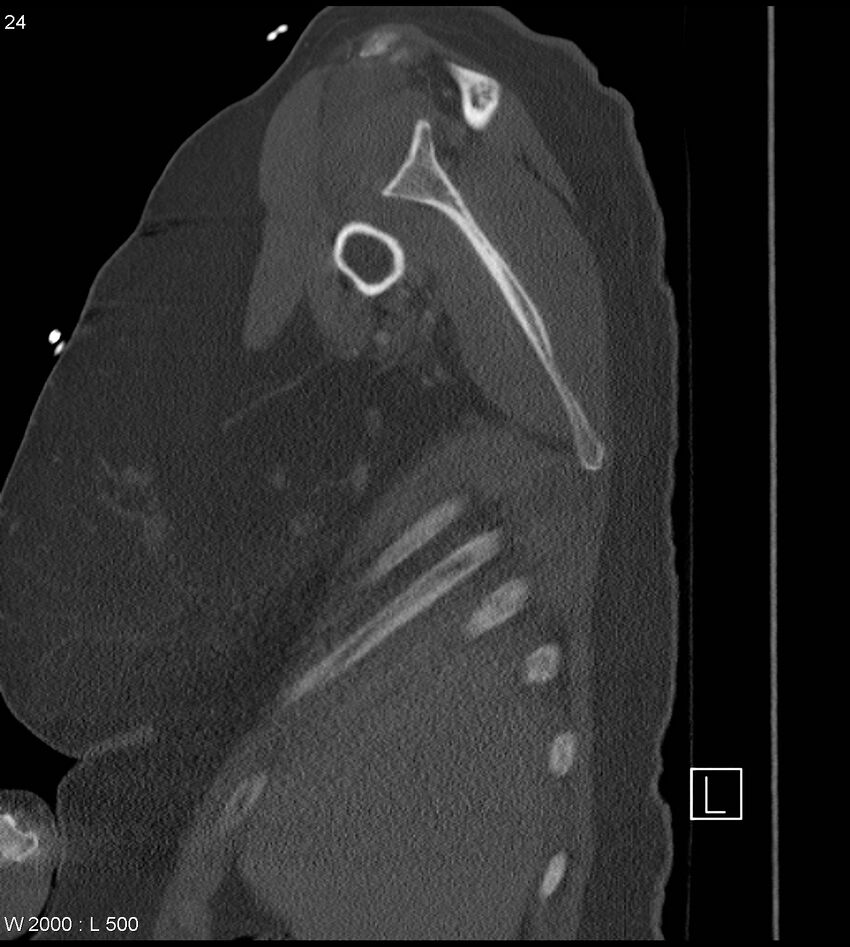 Anterior shoulder dislocation (CT) (Radiopaedia 59032-66309 Sagittal bone window 12).jpg