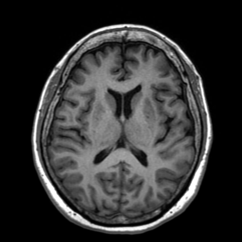 Anti-MOG encephalomyelitis (Radiopaedia 73831-84646 Axial T1 29).jpg
