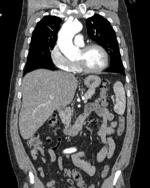 File:Aortic dissection (Radiopaedia 44411-48061 A 13).jpg