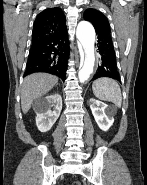 File:Aortic dissection (Radiopaedia 44411-48061 A 45).jpg