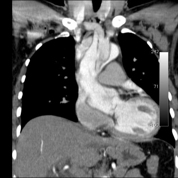 File:Aortic dissection - Stanford type A (Radiopaedia 29247-29659 B 26).jpg