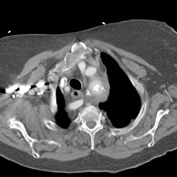 File:Aortic dissection and aberrant right subclavian (Radiopaedia 8935).jpg