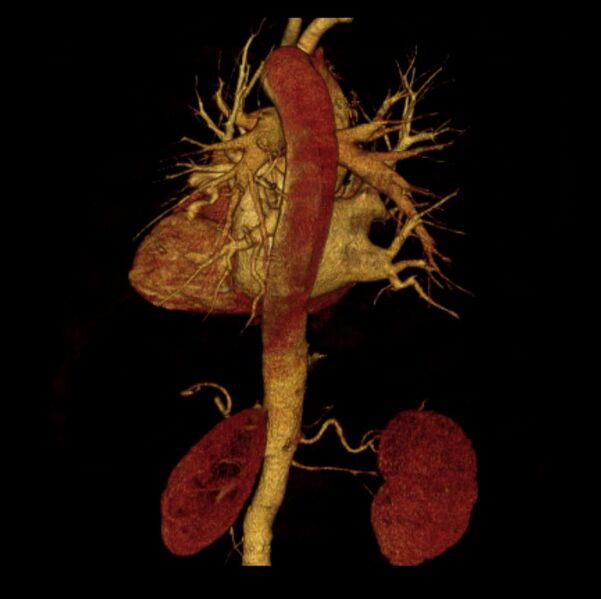 File:Aortic dissection with rupture into pericardium (Radiopaedia 12384-12647 D 22).jpg