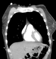 Aortic valve non-coronary cusp thrombus (Radiopaedia 55661-62189 C 21).png