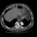 Aorto-coronary bypass graft aneurysms (Radiopaedia 40562-43157 A 101).png
