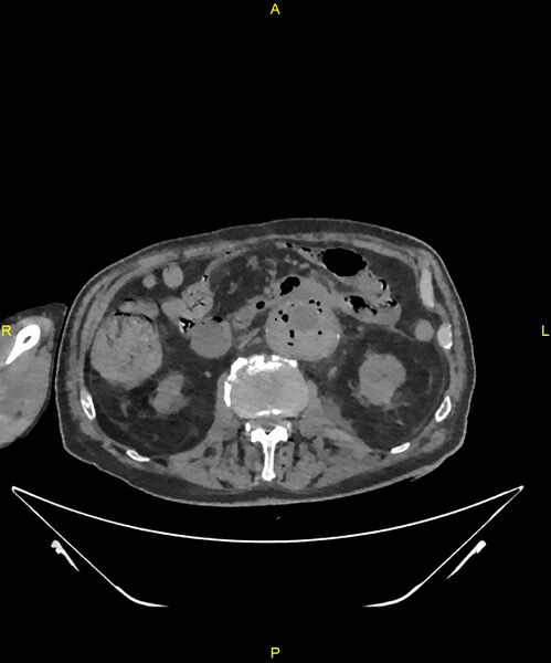 File:Aortoenteric fistula (Radiopaedia 84308-99603 Axial non-contrast 157).jpg