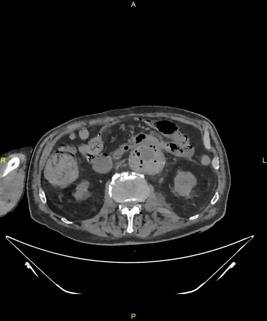 Aortoenteric fistula (Radiopaedia 84308-99603 Axial non-contrast 157).jpg