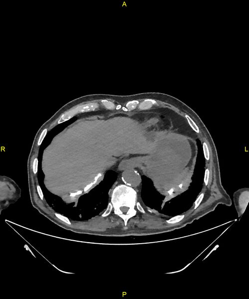 File:Aortoenteric fistula (Radiopaedia 84308-99603 Axial non-contrast 25).jpg