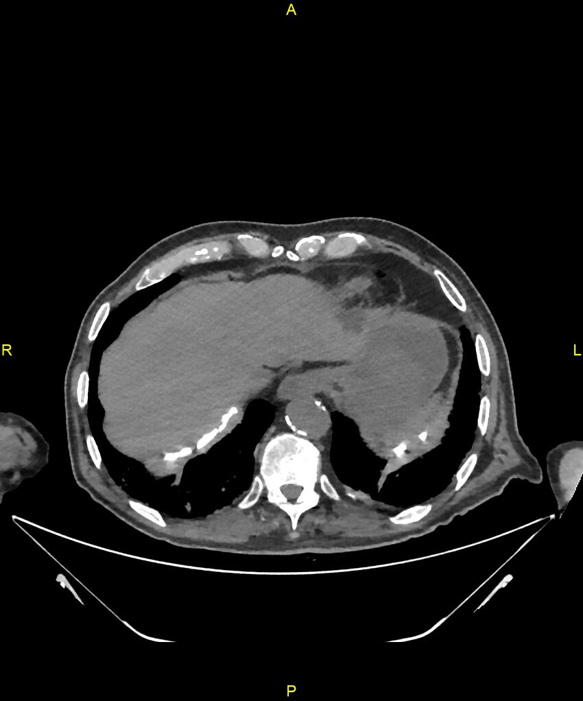 Aortoenteric fistula (Radiopaedia 84308-99603 Axial non-contrast 25).jpg