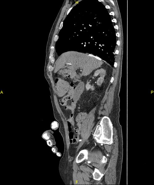 File:Aortoenteric fistula (Radiopaedia 84308-99603 C 114).jpg