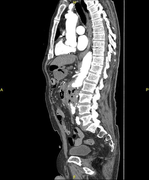 File:Aortoenteric fistula (Radiopaedia 84308-99603 C 185).jpg