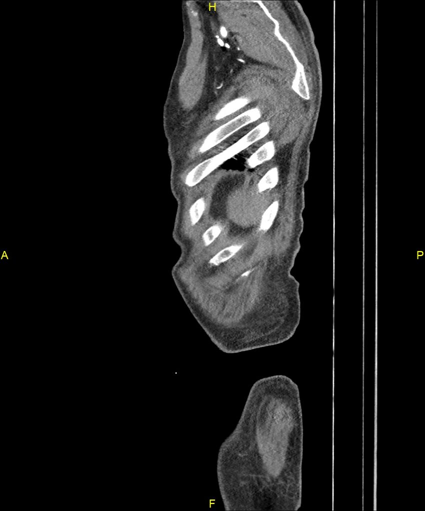 Aortoenteric fistula (Radiopaedia 84308-99603 C 323).jpg