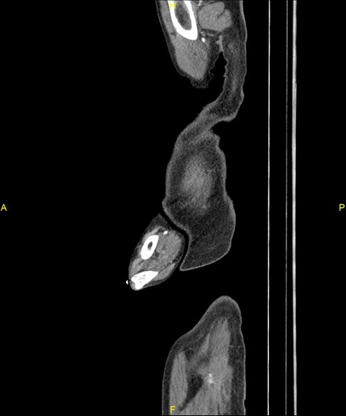 File:Aortoenteric fistula (Radiopaedia 84308-99603 C 7).jpg
