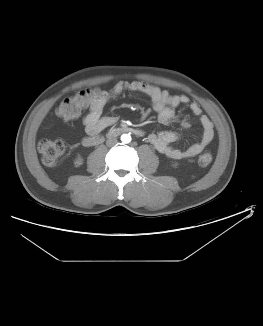 Aplastic posterior tibial arteries (Radiopaedia 84021-99249 A 62).jpg