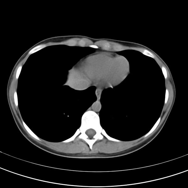 File:Appendicitis and incidental bicornuate uterus (Radiopaedia 22833-22853 Axial non-contrast 4).jpg