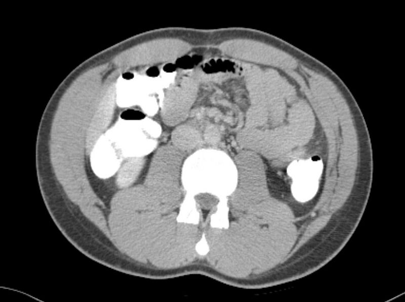 File:Appendicitis and incidental foregut duplication cyst (Radiopaedia 52962-58916 A 30).jpg