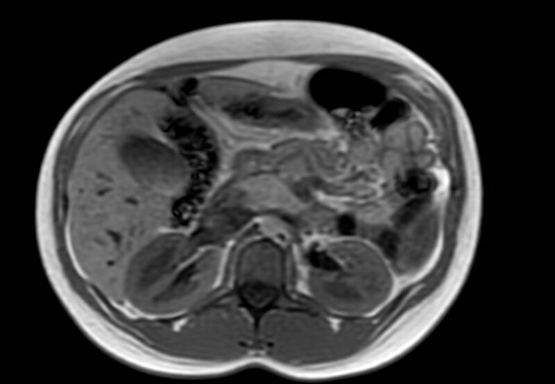 File:Appendicitis in gravida (MRI) (Radiopaedia 89433-106395 Axial T1 in-phase 22).jpg