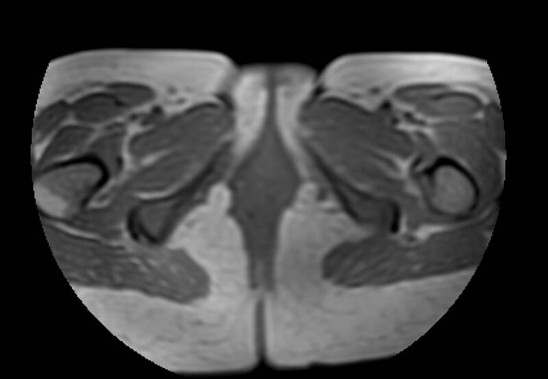 File:Appendicitis in gravida (MRI) (Radiopaedia 89433-106395 Axial T1 in-phase 75).jpg