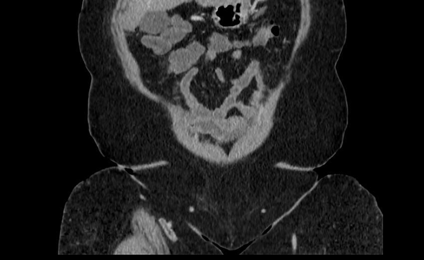 Appendix mucocele (Radiopaedia 41222-44033 B 1).jpg