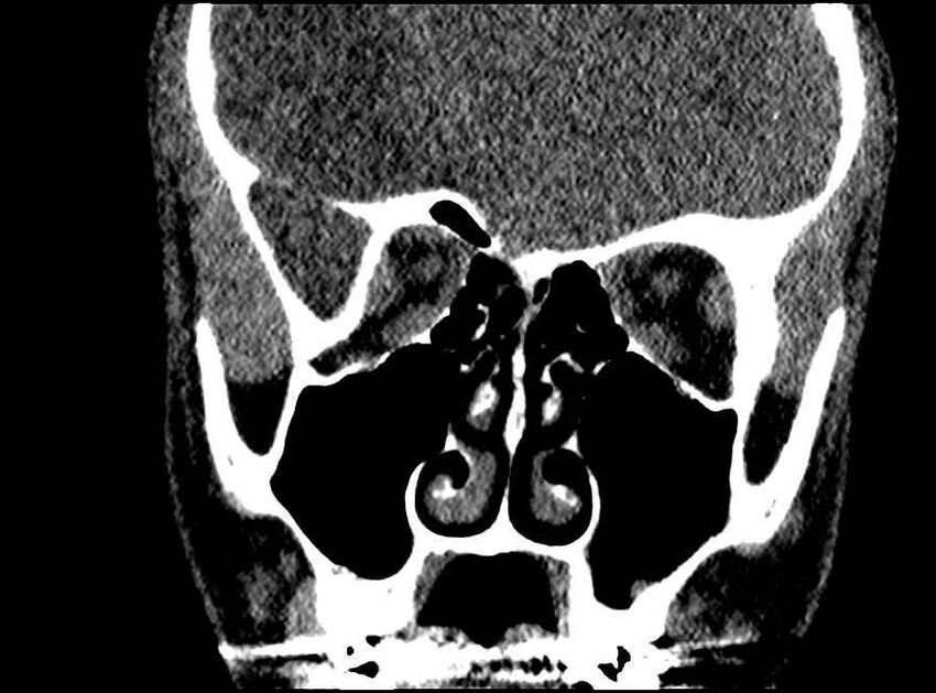 Arachnoid cyst- extremely large (Radiopaedia 68741-78450 Coronal bone window 44).jpg