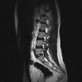 Arachnoid cyst - spinal (Radiopaedia 66835-76157 Sagittal T2 9).jpg
