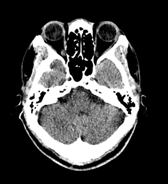 File:Arachnoid cyst of the ambient cistern (Radiopaedia 81301-94986 Axial non-contrast 17).jpg