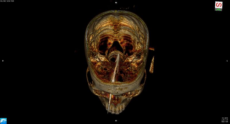 File:Arrow injury to the brain (Radiopaedia 72101-82607 3D bone 17).jpg