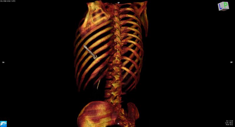 File:Arrow injury to the chest (Radiopaedia 75223-86321 3D bone 18).jpg