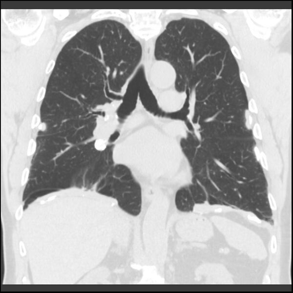 File:Asbestos-related pleural plaques (Radiopaedia 39069-41255 Coronal lung window 41).jpg
