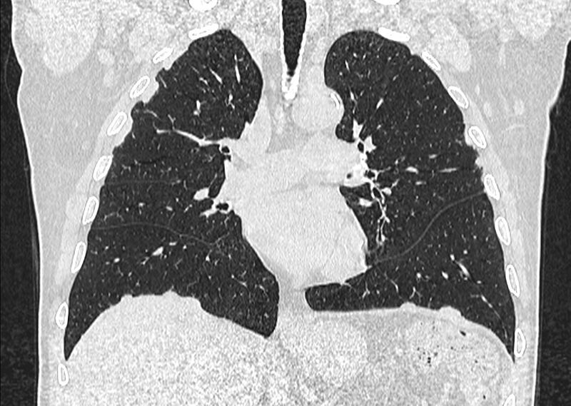 File:Asbestos pleural placques (Radiopaedia 57905-64872 Coronal lung window 138).jpg