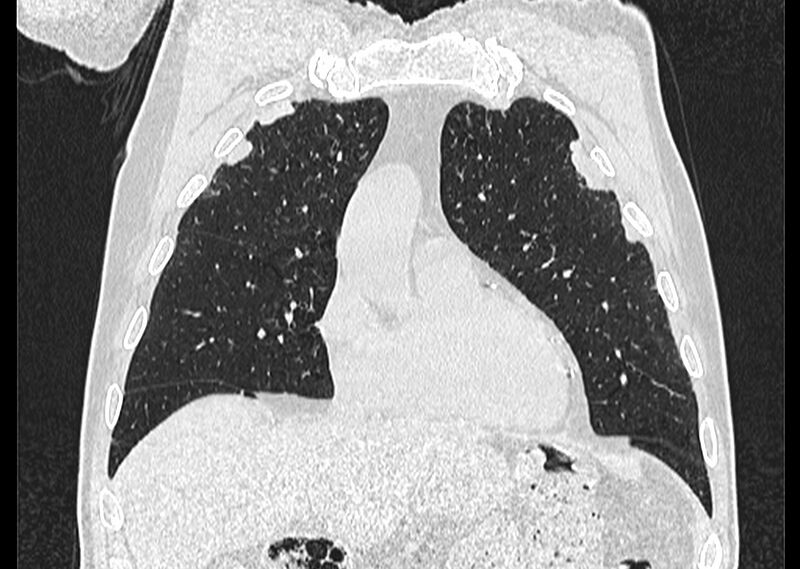 File:Asbestos pleural placques (Radiopaedia 57905-64872 Coronal lung window 77).jpg