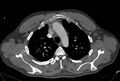 Ascending aortic aneurysm (Radiopaedia 86279-102297 C 13).jpg