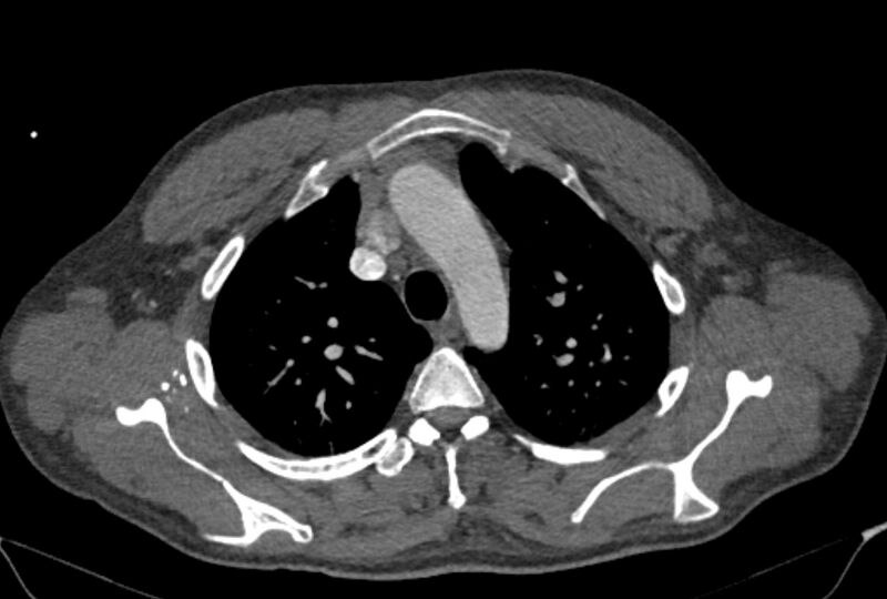 File:Ascending aortic aneurysm (Radiopaedia 86279-102297 C 13).jpg
