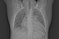 Ascending aortic aneurysm (Radiopaedia 86279-102297 frontal Topogram 1).jpg