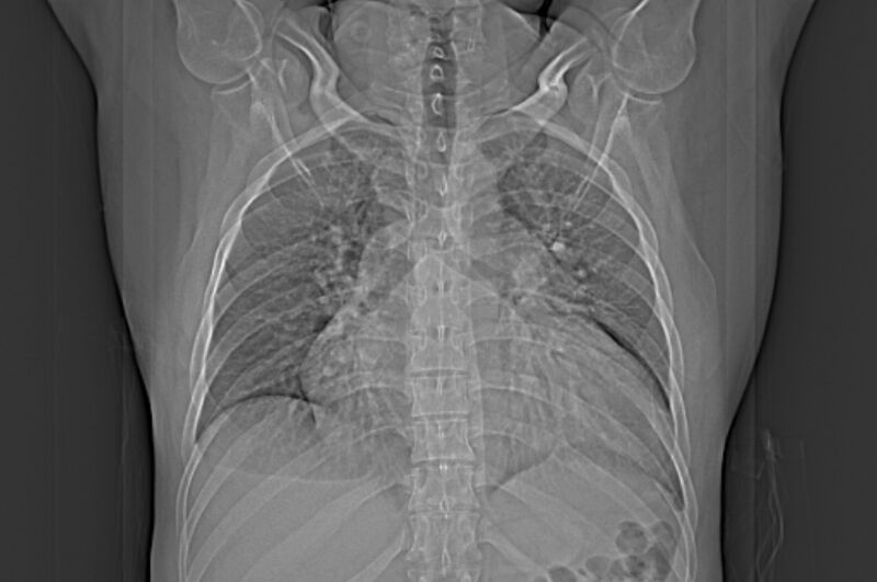 File:Ascending aortic aneurysm (Radiopaedia 86279-102297 frontal Topogram 1).jpg