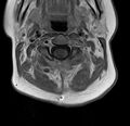 Astrocytoma - spinal cord (Radiopaedia 69769-79758 Axial T1 C+ 6).jpg