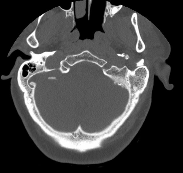 File:Atlanto-occipital assimilation with basilar invagination (Radiopaedia 70122-80188 Axial bone window 2).jpg