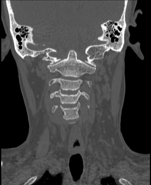 File:Atlanto-occipital assimilation with basilar invagination (Radiopaedia 70122-80188 Coronal bone window 89).jpg