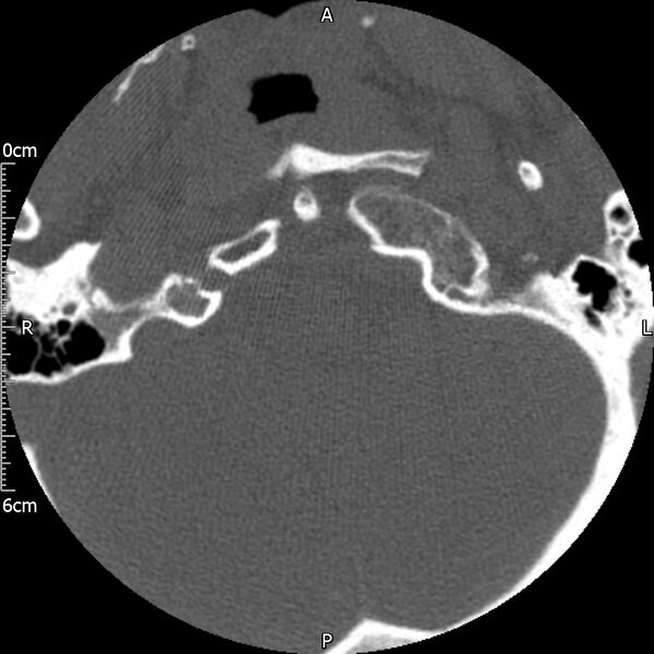 File:Atlas fracture with Currarino type A congenital defect (Radiopaedia 71747-82144 Axial bone window 11).jpg