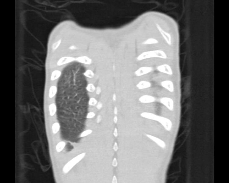 File:Atrial septal defect complicated by Eisenmenger syndrome (Radiopaedia 53707-59768 Sagittal lung window 21).jpg