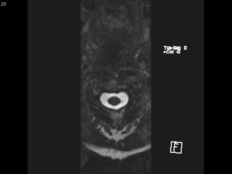 File:Atypical meningioma - intraosseous (Radiopaedia 64915-74572 Axial CISS 29).jpg