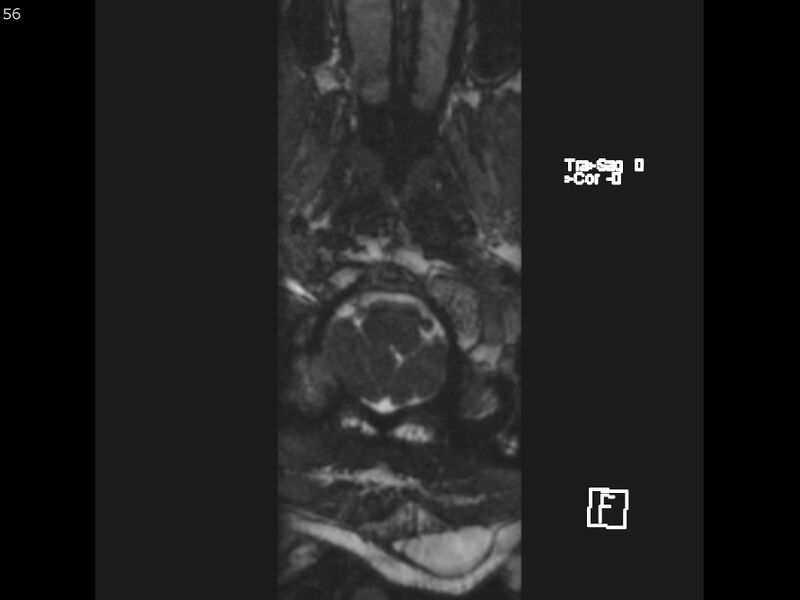 File:Atypical meningioma - intraosseous (Radiopaedia 64915-74572 Axial CISS 56).jpg