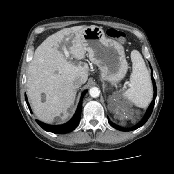 File:Autosomal dominant polycystic kidney disease (Radiopaedia 27851-28094 B 56).jpg